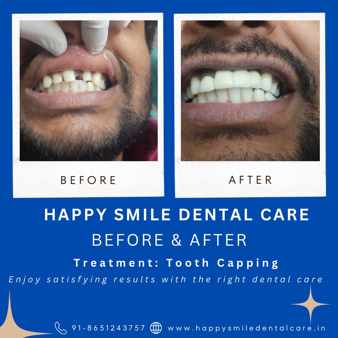 Before and after dental transformation by happy smile patna (1)