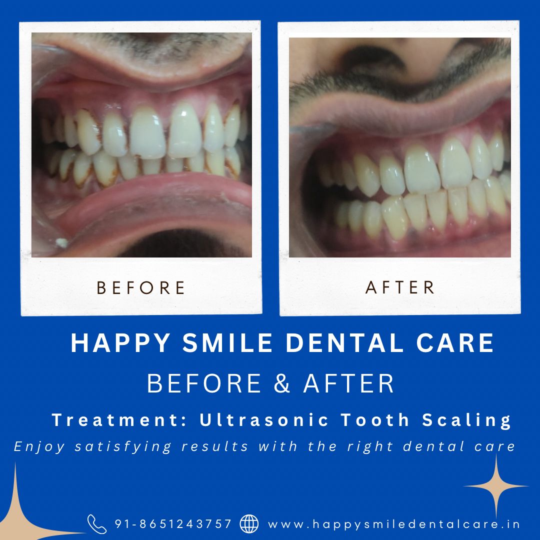 Before and after dental transformation by happy smile patna (2)