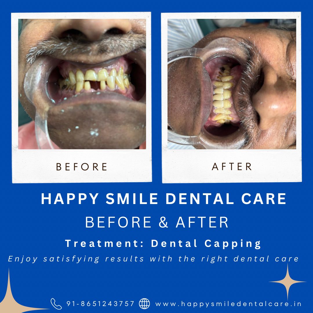 Before and after dental transformation by happy smile patna (3)
