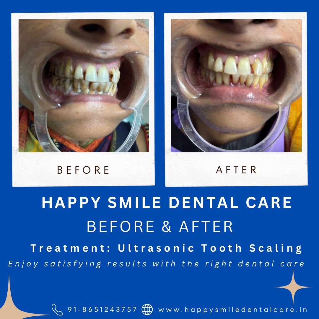 Before and after dental transformation by happy smile patna (4)