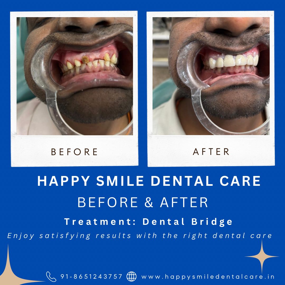Before and after dental transformation by happy smile patna (5)